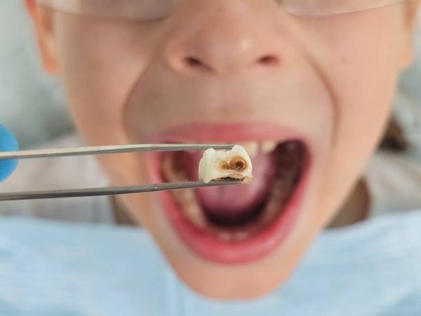Best Emergency Wisdom Teeth Removal in Farmland, IN